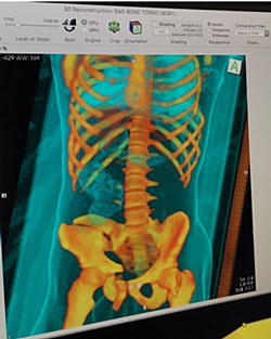 Three-Dimensional Scan and CT Scan