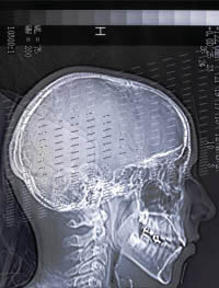 xray of human skull