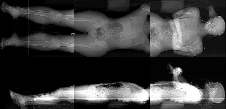 De-identified computed tomography scan