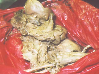 Image of tissue, organ, and bone evidence